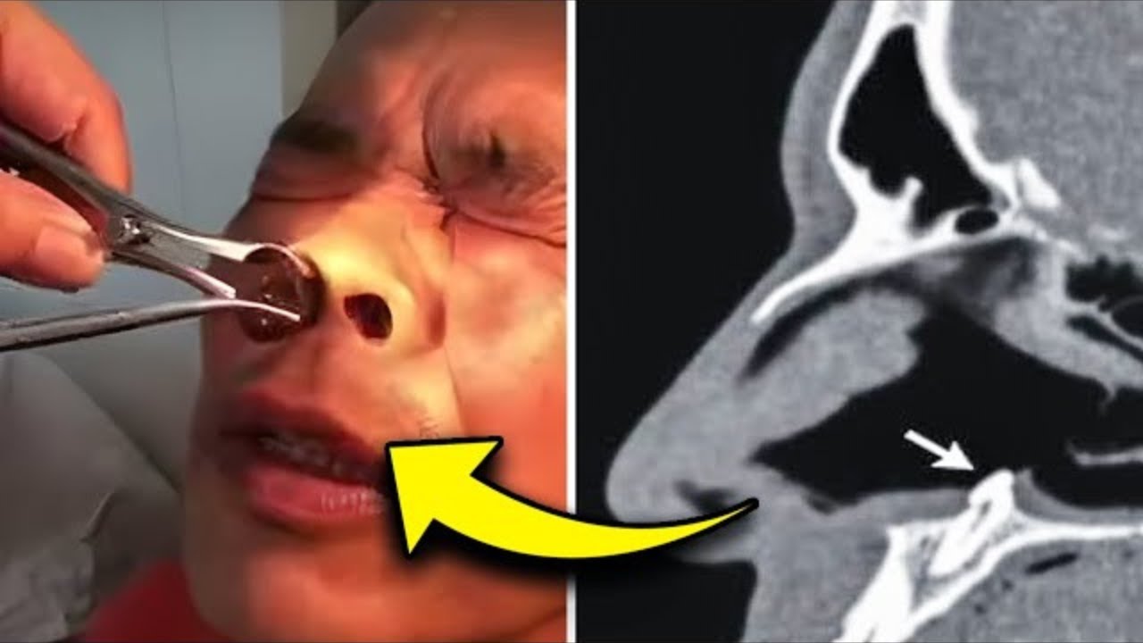 Burri kishte kruarje intensive për shumë vite.Ajo që mjeku gjeti në hundën e tij është e pabesueshme