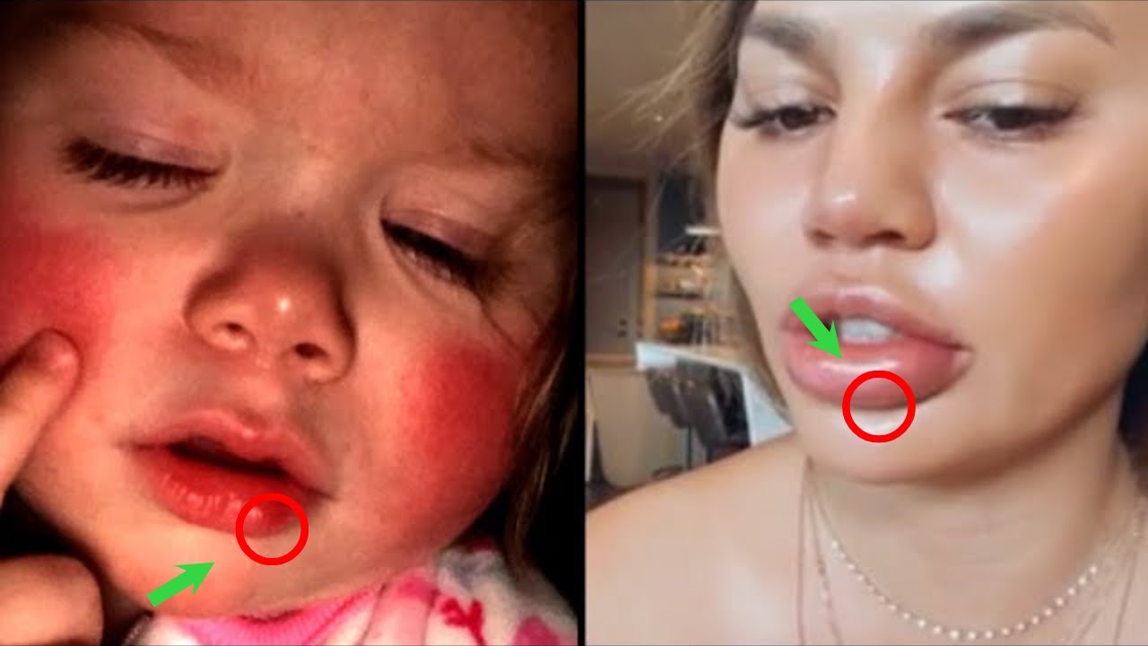 “Alergjia nuk do t’ju shqetësojë më! Zbuloni ushqimet që e luftojnë natyrshëm”