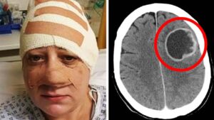 Pacientët që përjetuan kimioterapinë ndajnë përvojat emocionuese dhe të vështira nga trajtimi