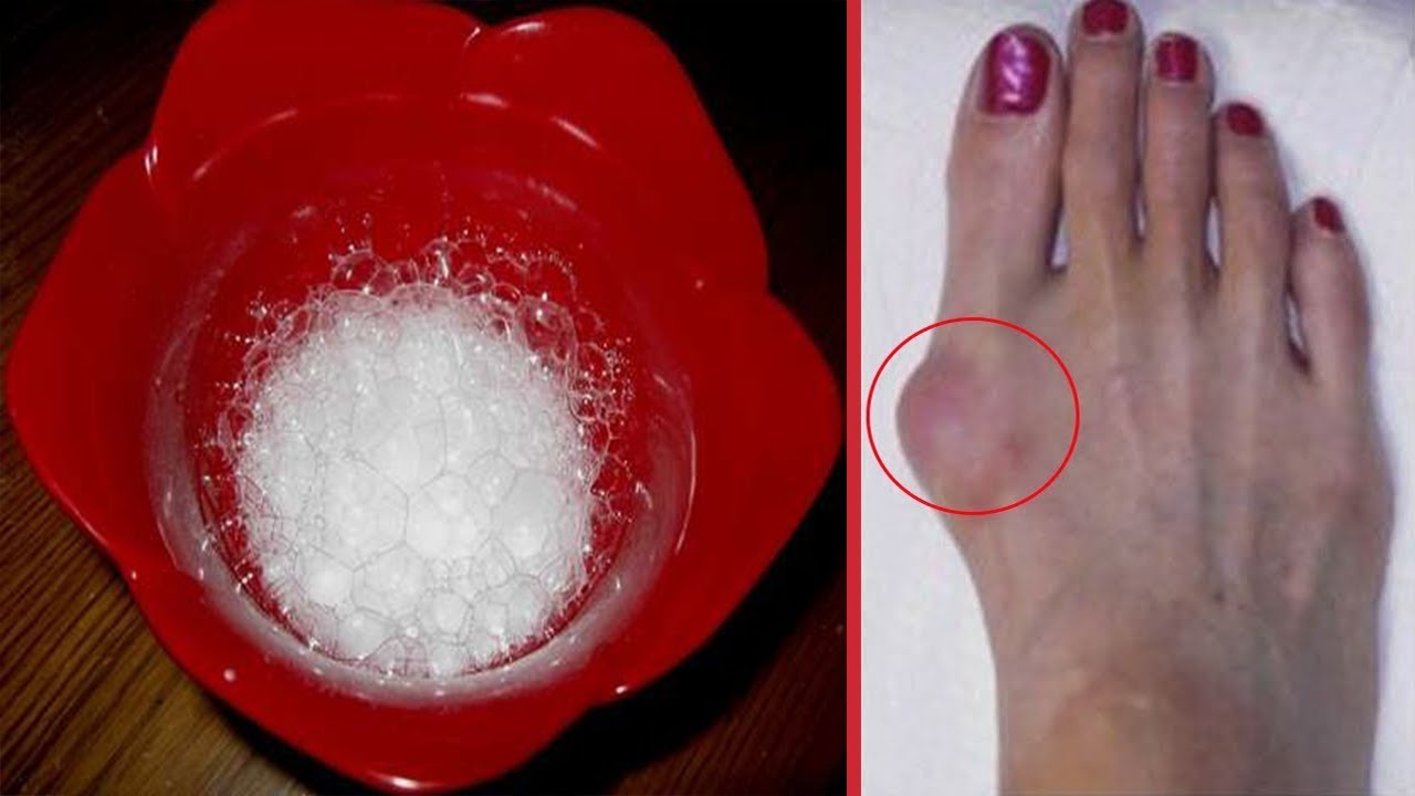 Mjekët e mbajnë sekret por ja receta që “zhduk” gungat kockore në kohë rekord