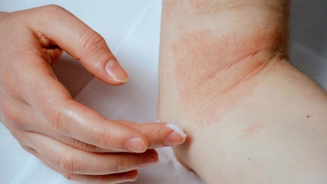 Dimri i ftohtë dhe lëkura me ekzema: Çfarë duhet të dini