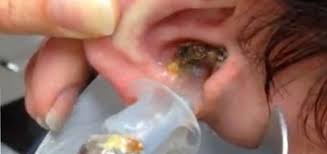 Ky djalë kishte probleme me dëgjimin. Nuk do ta besoni se çfarë i nxorën nga veshët e tij!