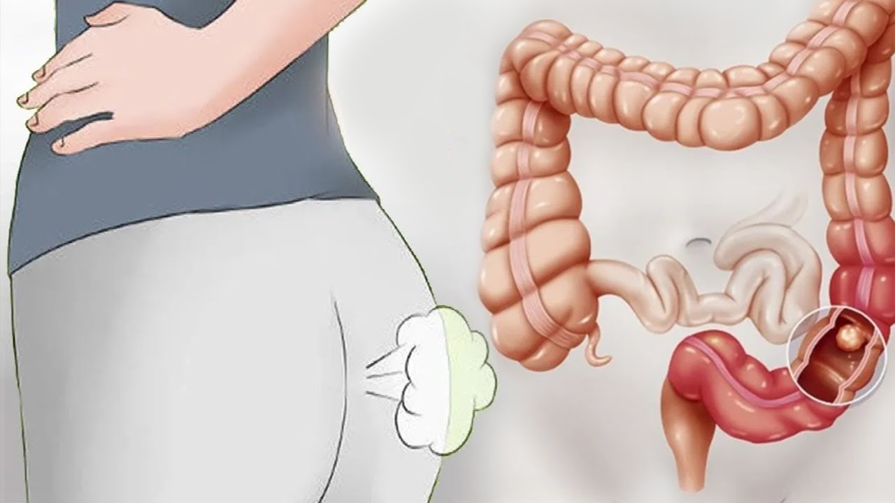 Nëse vuani nga gazrat dhe fryrja e barkut, një lugë nga kjo do ju shpëtoj nga ky problem