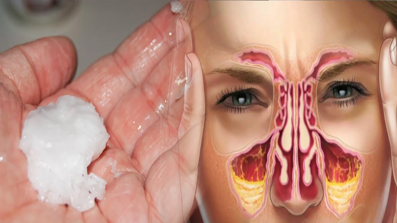 Nëse vuani nga bllokimi i sinuseve në dimër, merrni 1 lugë nga kjo dhe do bëj mrekulli