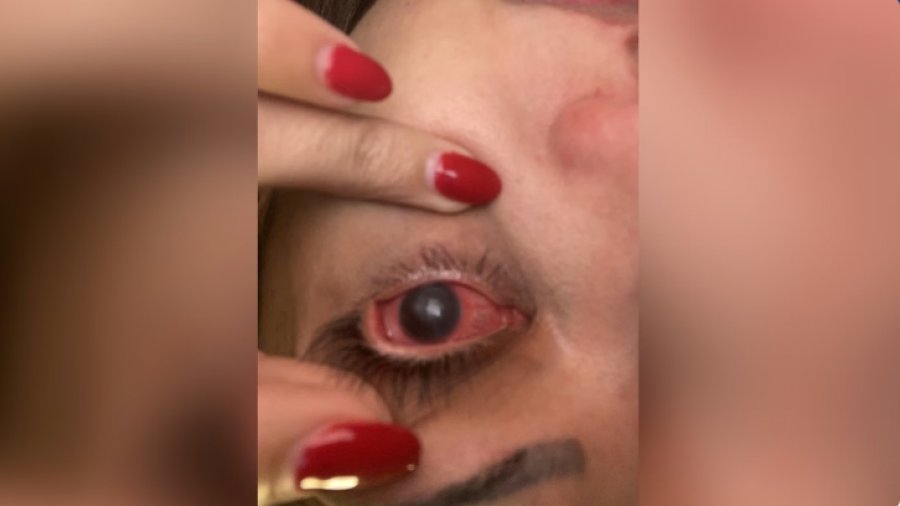 Sëmundja verbuese parazitare e syrit që prek më shpesh ata që mbajnë lente kontakti