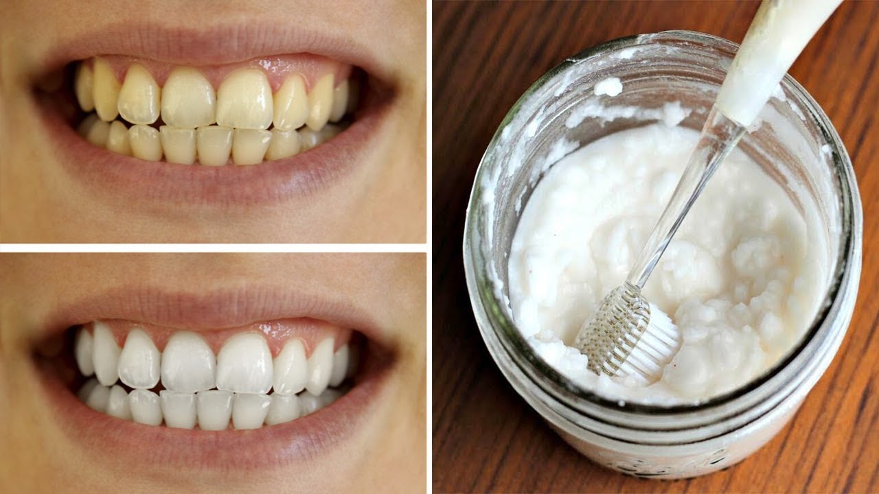Doni dhëmbë të bardhë si bora? Kjo është receta që do t’ju lërë pa fjalë me rezultatin